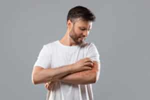 A man with psoriasis scratching his arm